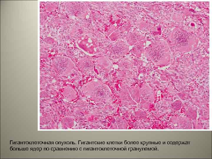 Гигантоклеточная опухоль. Гигантские клетки более крупные и содержат больше ядер по сравнению с гигантоклеточной