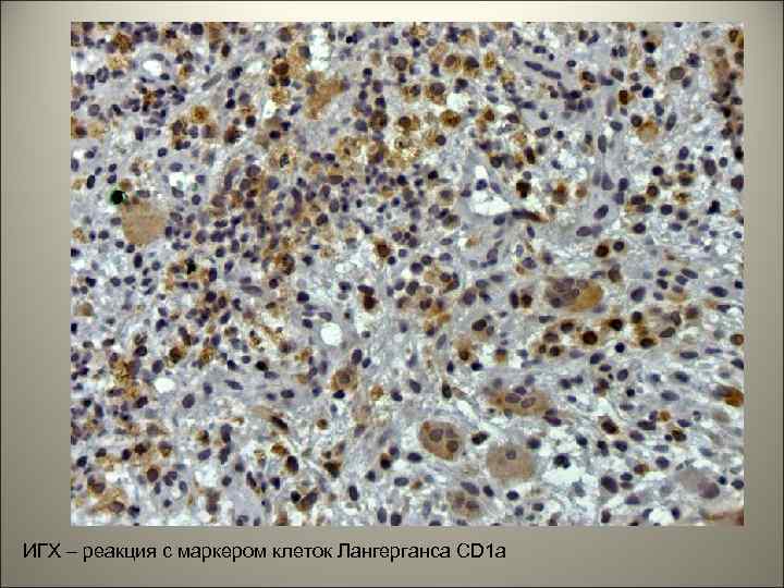 ИГХ – реакция с маркером клеток Лангерганса CD 1 a 
