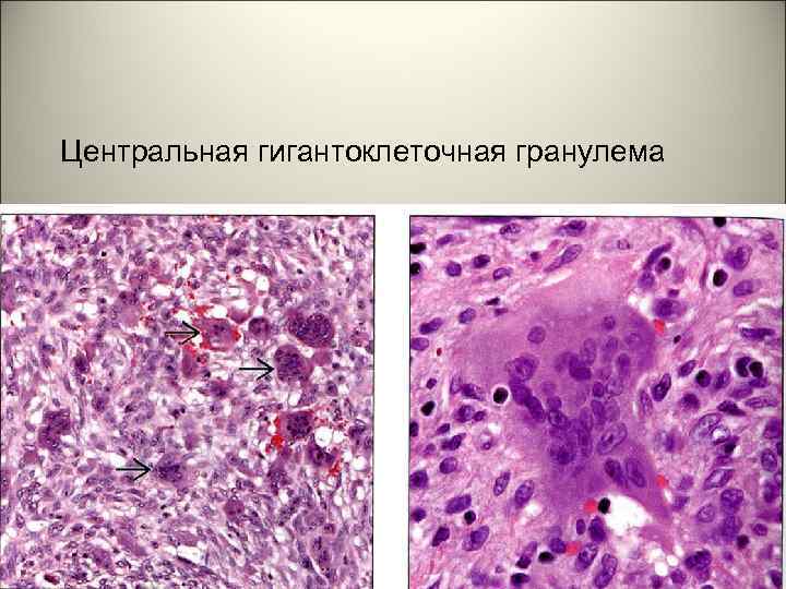 Центральная гигантоклеточная гранулема 