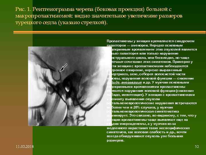 Рис. 1. Рентгенограмма черепа (боковая проекция) больной с макропролактиномой: видно значительное увеличение размеров турецкого