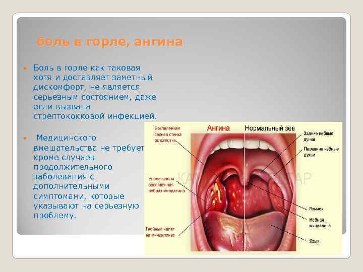 боль в горле, ангина Боль в горле как таковая хотя и доставляет заметный дискомфорт,