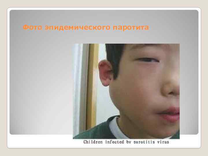 Фото эпидемического паротита 