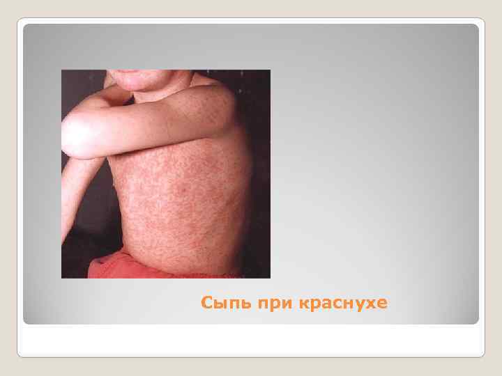 Сыпь при краснухе 