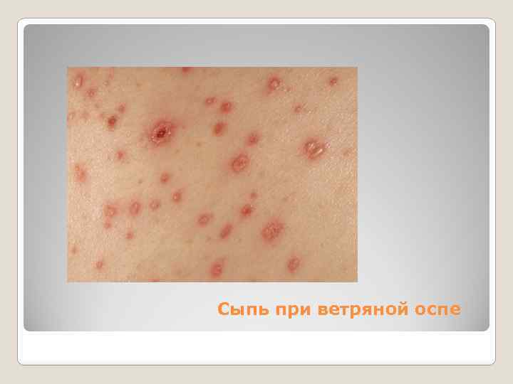 Сыпь при ветряной оспе 