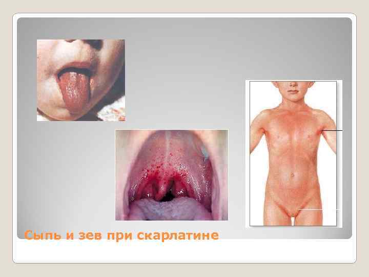 Сыпь и зев при скарлатине 
