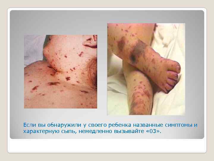 Если вы обнаружили у своего ребенка названные симптомы и характерную сыпь, немедленно вызывайте «