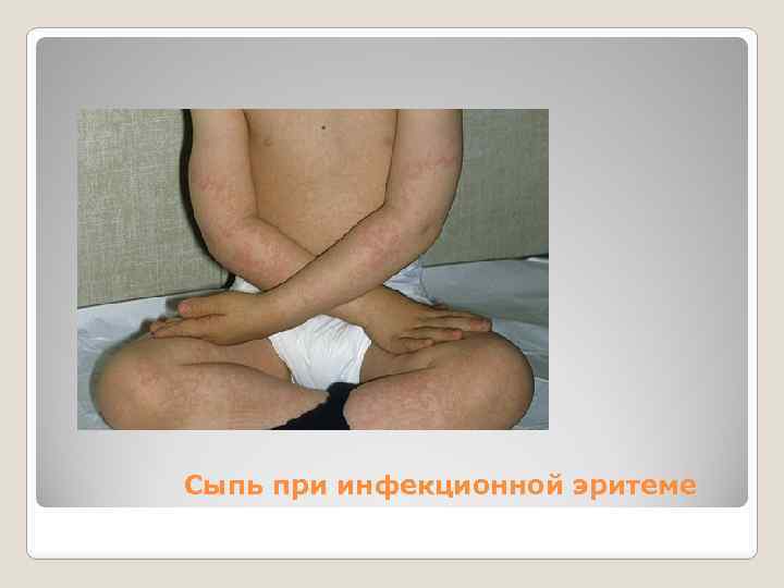 Сыпь при инфекционной эритеме 