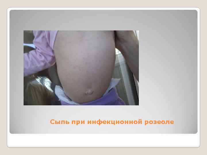  Сыпь при инфекционной розеоле 
