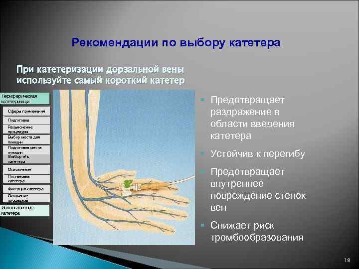 Рекомендации по выбору катетера При катетеризации дорзальной вены используйте самый короткий катетер Периферическая катетеризация