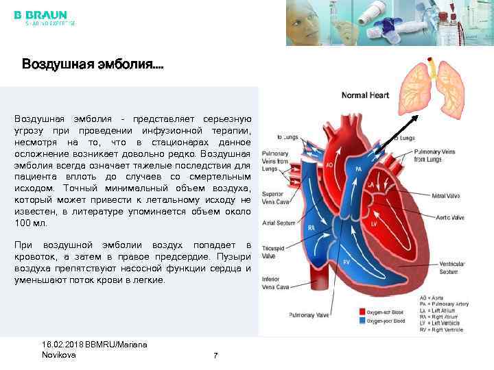 Воздушная эмболия картинки