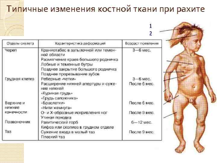 Типичные изменения костной ткани при рахите 