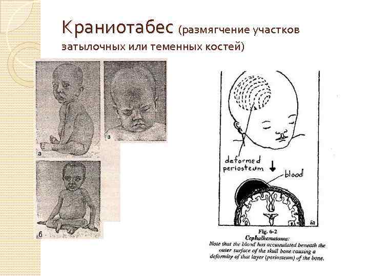Краниотабес (размягчение участков затылочных или теменных костей) 