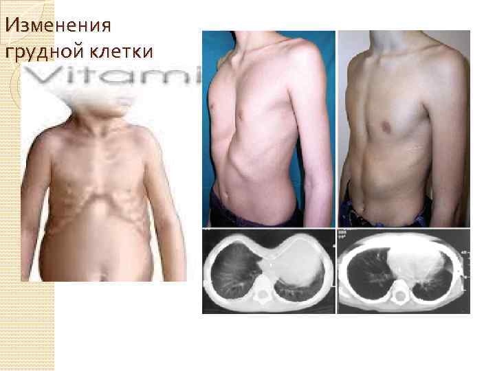 Изменения грудной клетки 