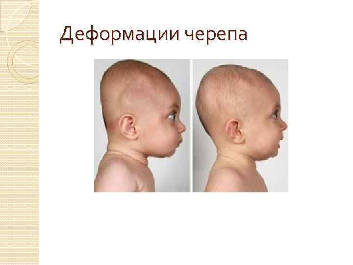 Деформации черепа 