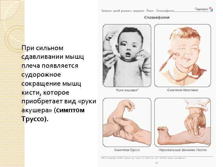 При сильном сдавливании мышц плеча появляется судорожное сокращение мышц кисти, которое приобретает вид «руки