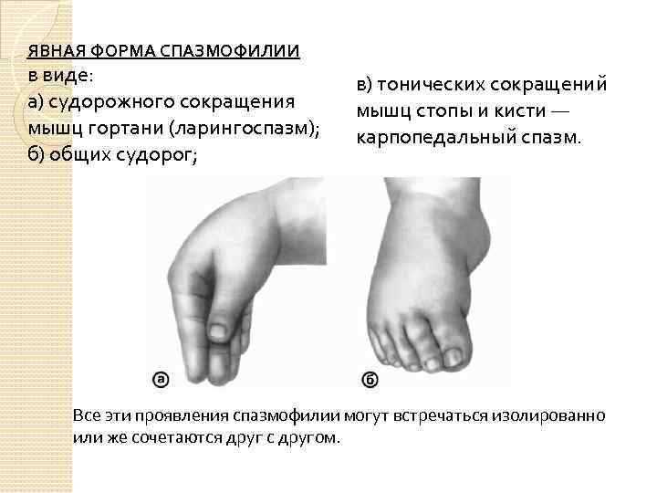 ЯВНАЯ ФОРМА СПАЗМОФИЛИИ в виде: а) судорожного сокращения мышц гортани (ларингоспазм); б) общих судорог;