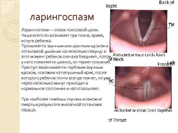 ларингоспазм Ларингоспазм — спазм голосовой щели. Чаще всего он возникает при плаче, крике, испуге