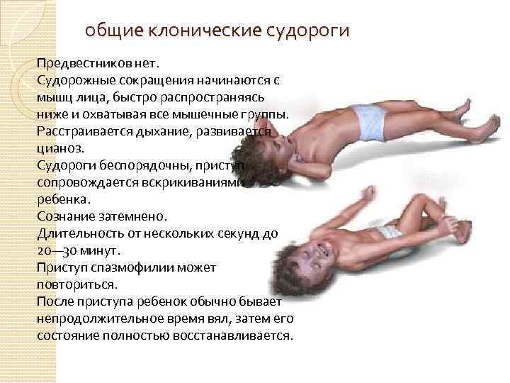 общие клонические судороги Предвестников нет. Судорожные сокращения начинаются с мышц лица, быстро распространяясь ниже