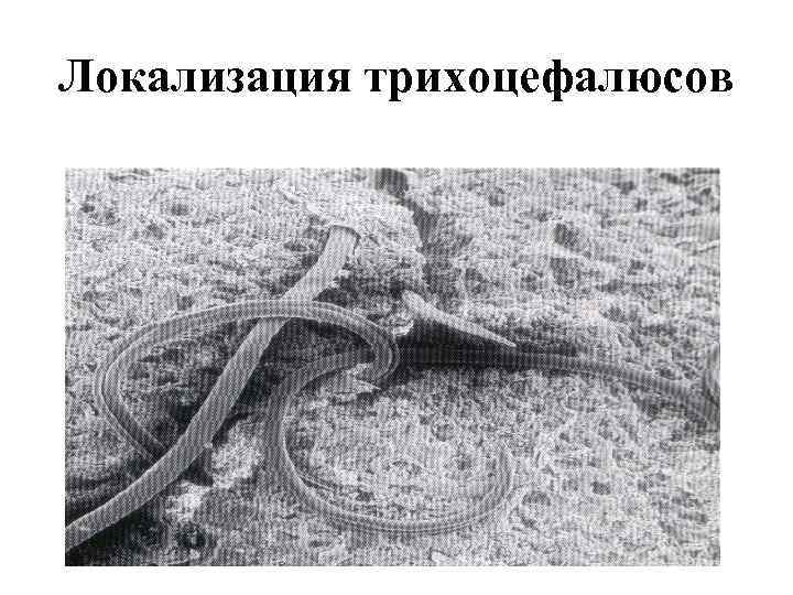 Локализация трихоцефалюсов 