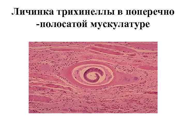 Личинка трихинеллы в поперечно -полосатой мускулатуре 
