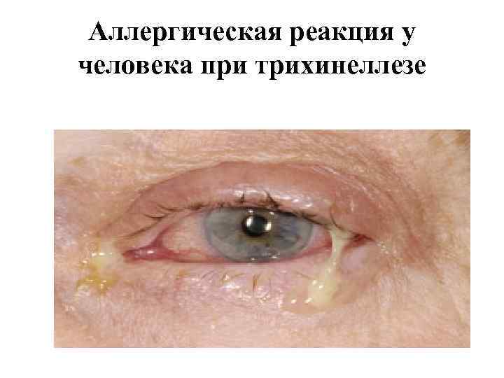 Аллергическая реакция у человека при трихинеллезе 