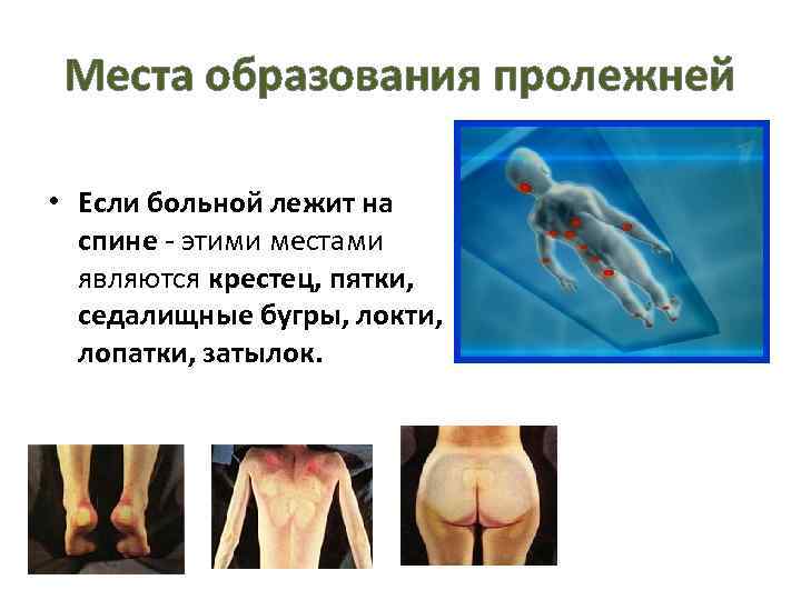 Места образования пролежней • Если больной лежит на спине - этими местами являются крестец,