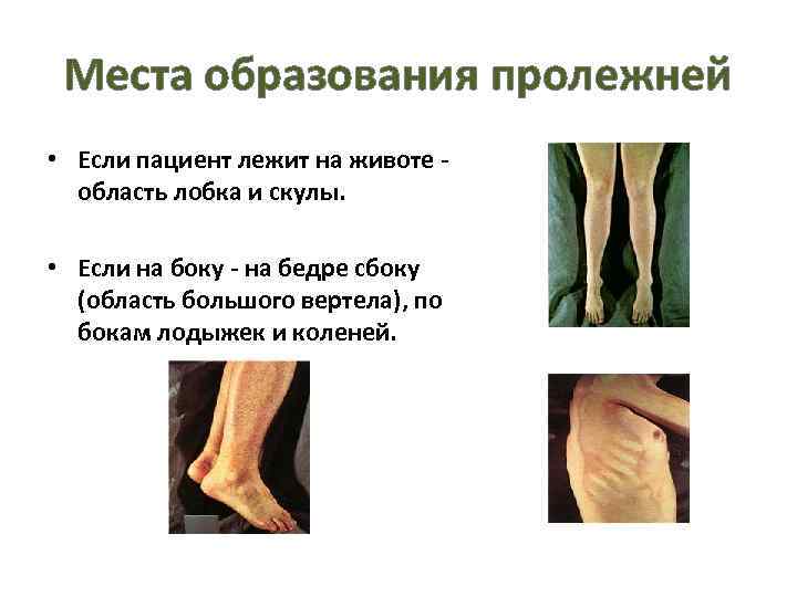 Места образования пролежней • Если пациент лежит на животе область лобка и скулы. •