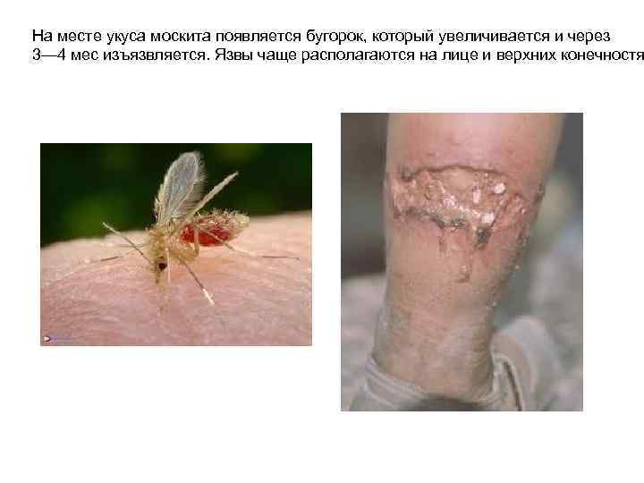 На месте укуса москита появляется бугорок, который увеличивается и через 3— 4 мес изъязвляется.