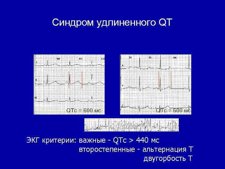 Cиндром удлиненного QT QTc = 600 мс ЭКГ критерии: важные - QTc > 440