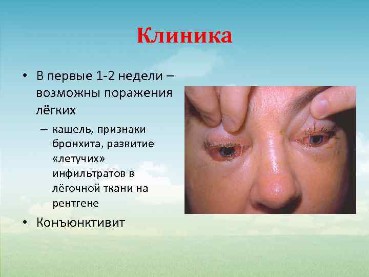 Клиника • В первые 1 -2 недели – возможны поражения лёгких – кашель, признаки