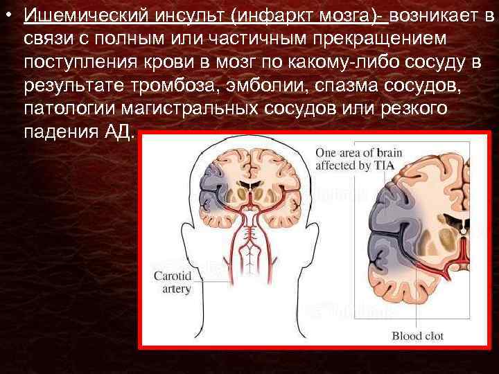 Последствия инфаркта мозга