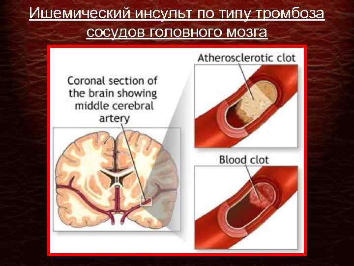 Ишемический инсульт по типу тромбоза сосудов головного мозга 