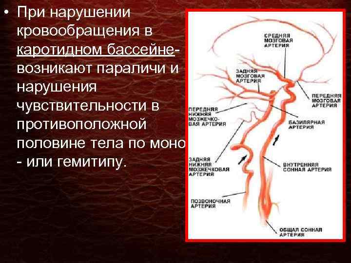  • При нарушении кровообращения в каротидном бассейне- возникают параличи и нарушения чувствительности в