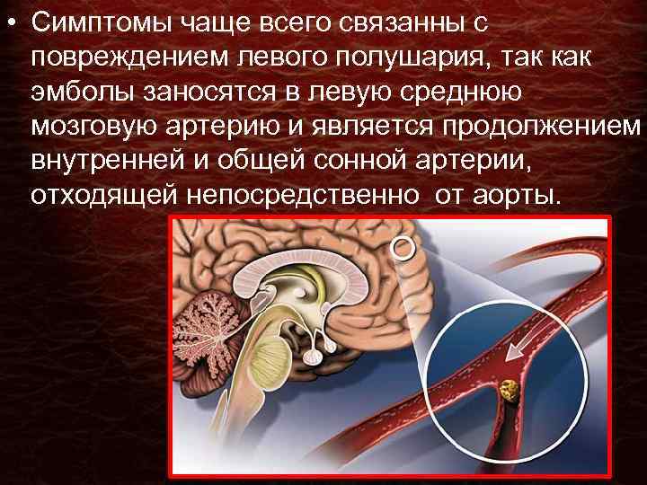  • Симптомы чаще всего связанны с повреждением левого полушария, так как эмболы заносятся