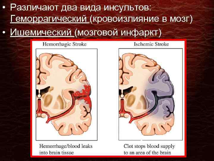  • Различают два вида инсультов: Геморрагический (кровоизлияние в мозг) • Ишемический (мозговой инфаркт)