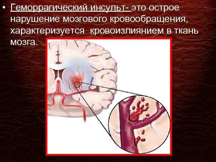  • Геморрагический инсульт- это острое нарушение мозгового кровообращения, характеризуется кровоизлиянием в ткань мозга.