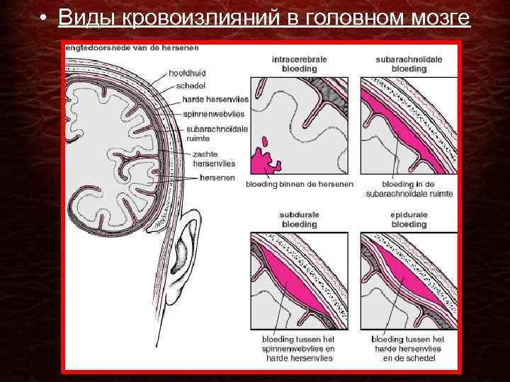  • Виды кровоизлияний в головном мозге 