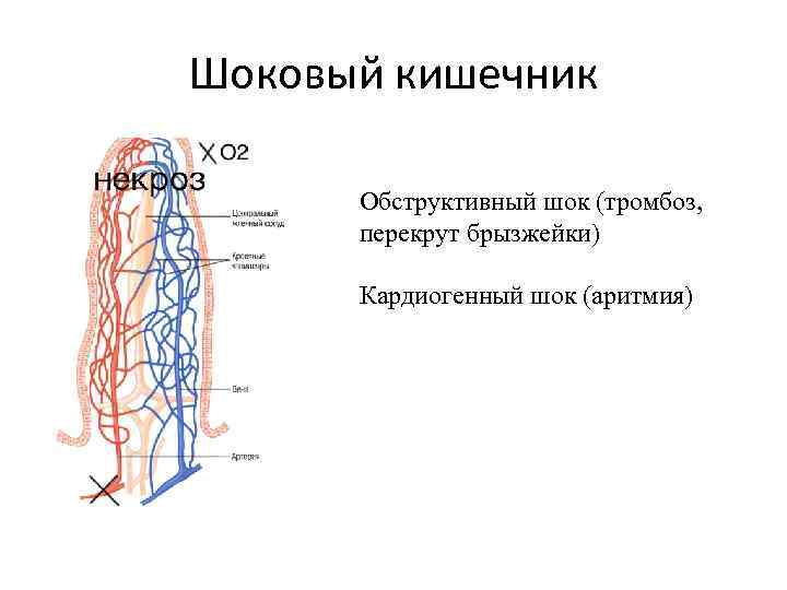 Шоковый кишечник Обструктивный шок (тромбоз, перекрут брызжейки) Кардиогенный шок (аритмия) 