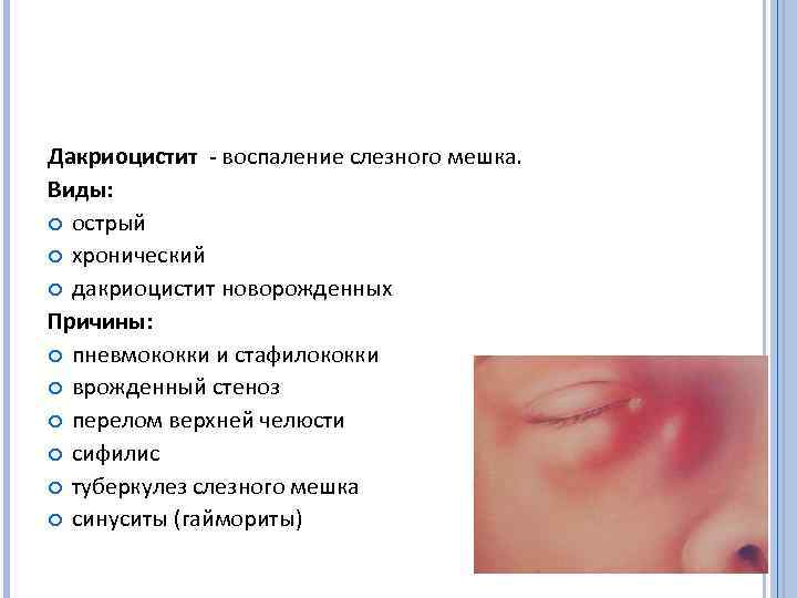 Дакриоцистит - воспаление слезного мешка. Виды: острый хронический дакриоцистит новорожденных Причины: пневмококки и стафилококки