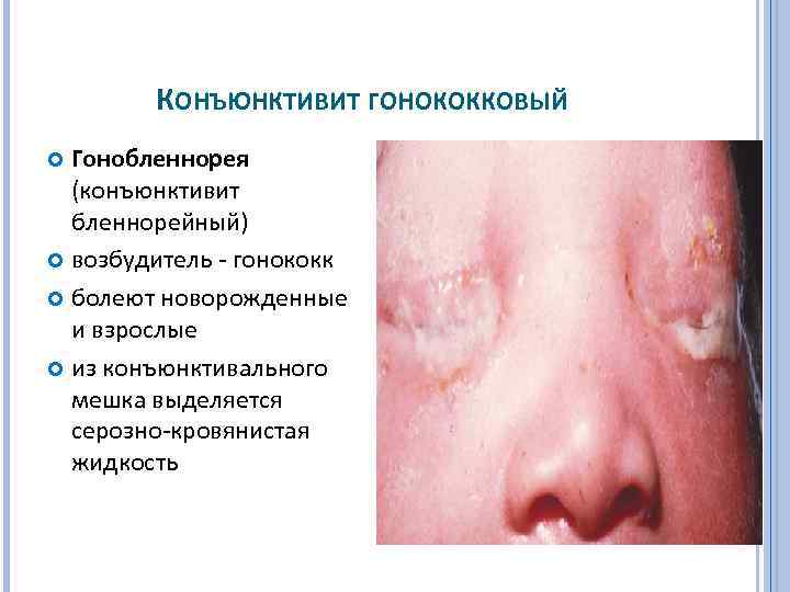 КОНЪЮНКТИВИТ ГОНОКОККОВЫЙ Гонобленнорея (конъюнктивит бленнорейный) возбудитель гонококк болеют новорожденные и взрослые из конъюнктивального мешка