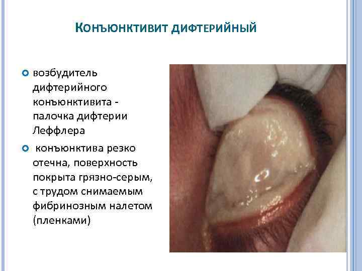 КОНЪЮНКТИВИТ ДИФТЕРИЙНЫЙ возбудитель дифтерийного конъюнктивита палочка дифтерии Леффлера конъюнктива резко отечна, поверхность покрыта грязно