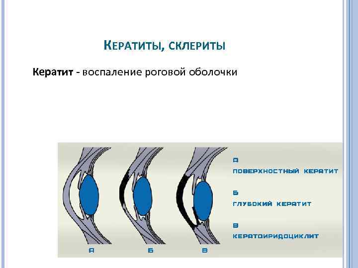 КЕРАТИТЫ, СКЛЕРИТЫ Кератит воспаление роговой оболочки 