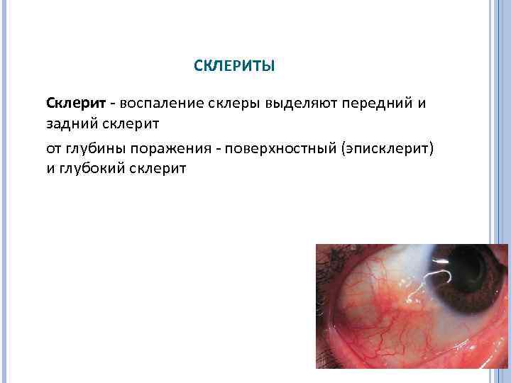 СКЛЕРИТЫ Склерит - воспаление склеры выделяют передний и задний cклерит от глубины поражения поверхностный