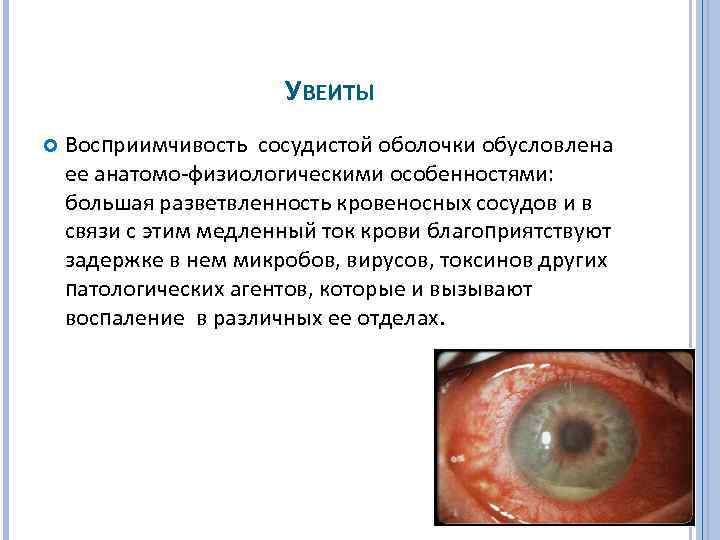УВЕИТЫ Восприимчивость сосудистой оболочки обусловлена ее анатомо физиологическими особенностями: большая разветвленность кровеносных сосудов и