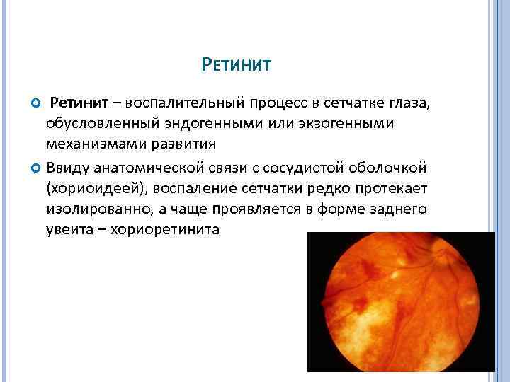  РЕТИНИТ Ретинит – воспалительный процесс в сетчатке глаза, обусловленный эндогенными или экзогенными механизмами