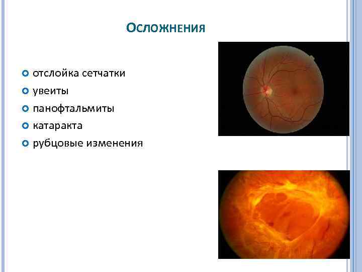 ОСЛОЖНЕНИЯ отслойка сетчатки увеиты панофтальмиты катаракта рубцовые изменения 