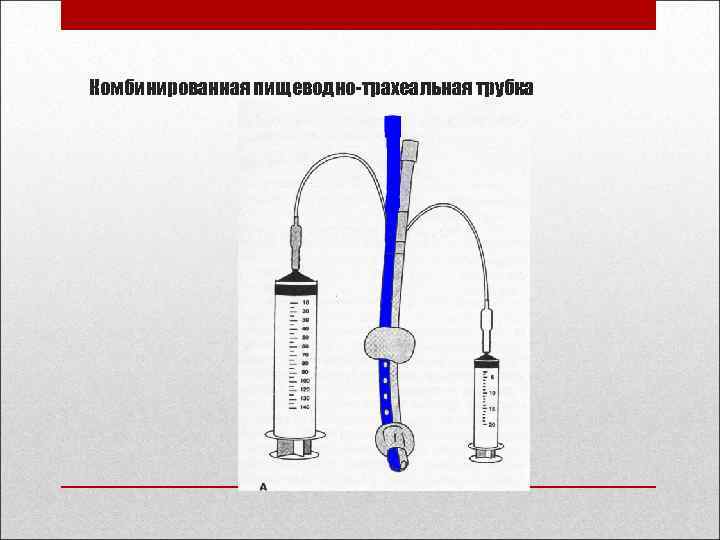 Комбинированная пищеводно-трахеальная трубка 