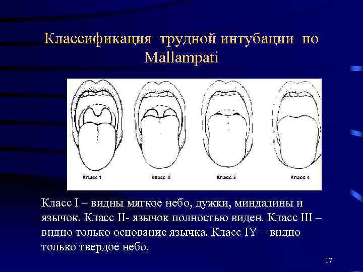 Классификация трудной интубации по Mallampati Класс I – видны мягкое небо, дужки, миндалины и