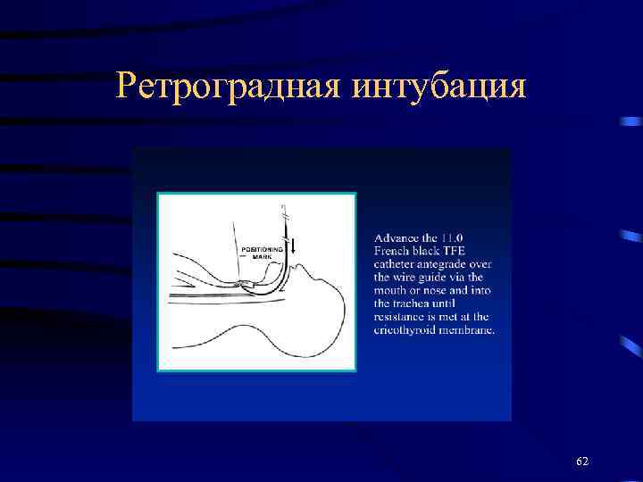 Ретроградная интубация 62 