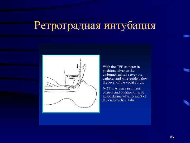 Ретроградная интубация 63 